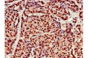 Immunohistochemistry of paraffin-embedded human ovarian cancer using ABIN7164525 at dilution of 1:100 (EARS2 antibody  (AA 42-166))