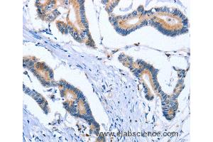 Immunohistochemistry of Human colon cancer using PLK3 Polyclonal Antibody at dilution of 1:30