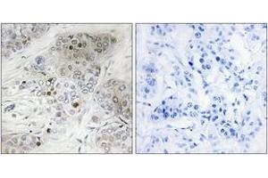 Immunohistochemistry analysis of paraffin-embedded human breast carcinoma, using p53 (Phospho-Ser9) Antibody. (p53 antibody  (pSer9))