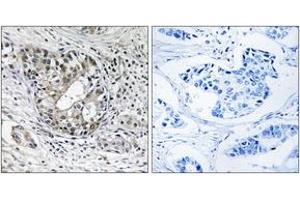Immunohistochemistry analysis of paraffin-embedded human breast carcinoma tissue, using PNPT1 Antibody. (PNPT1 antibody  (AA 570-619))
