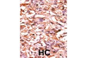 Formalin-fixed and paraffin-embedded human hepatocellular carcinoma tissue reacted with CDC25B (phospho S187) polyclonal antibody  which was peroxidase-conjugated to the secondary antibody followed by AEC staining. (CDC25B antibody  (pSer187))