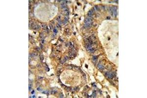 Immunohistochemistry analysis in formalin-fixed and paraffin-embedded human colon carcinoma reacted with Beta-glucuronidase Antibody (Center) followed which was peroxidase-conjugated to the secondary antibody, followed by DAB staining. (Glucuronidase beta antibody  (Middle Region))