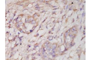 Formalin-fixed and paraffin embedded human lung carcinoma labeled with Anti-SAPK3 (Thr183+Tyr185) Polyclonal Antibody, Unconjugated  at 1:200 followed by conjugation to the secondary antibody and DAB staining (MAPK12 antibody  (pThr183, pTyr185))