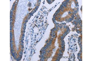 Immunohistochemistry of Human colon cancer using IDH2 Polyclonal Antibody at dilution of 1:60 (IDH2 antibody)