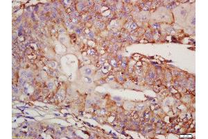 Formalin-fixed and paraffin embedded human lung carcinoma labeled with Rabbit Anti-MAG1 Polyclonal Antibody, Unconjugated (ABIN717896) at 1:200 followed by conjugation to the secondary antibody and DAB staining (AGPAT9 antibody  (AA 65-160))