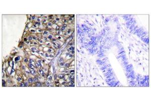 Immunohistochemical analysis of paraffin-embedded human lung carcinoma tissue using Claudin 7 antibody (ABIN5976363).