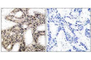 Immunohistochemical analysis of paraffin-embedded human breast carcinoma tissue using 4E-BP1 (phospho-Thr45) antibody (E011223). (eIF4EBP1 antibody  (pThr45))
