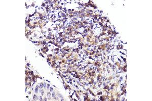 Immunohistochemistry of paraffin-embedded human esophageal cancer using CMIP Rabbit pAb (ABIN7265970) at dilution of 1:25 (40x lens).