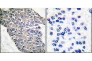 Immunohistochemistry analysis of paraffin-embedded human breast carcinoma tissue, using Synaptotagmin (Ab-202) Antibody. (Synaptotagmin antibody  (AA 176-225))