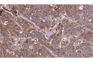 ABIN6273449 at 1/100 staining Human liver cancer tissue by IHC-P. (CD48 antibody  (Internal Region))