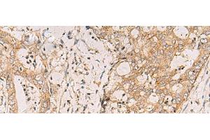 Immunohistochemistry of paraffin-embedded Human cervical cancer tissue using FYCO1 Polyclonal Antibody at dilution of 1:110(x200) (FYCO1 antibody)