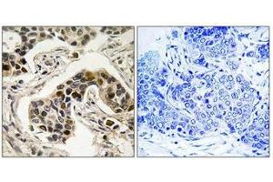 Immunohistochemistry analysis of paraffin-embedded human breast carcinoma tissue using NudC (Phospho-Ser326) antibody. (NUDC antibody  (pSer326))