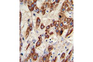 Formalin-fixed and paraffin-embedded human hepatocarcinoma reacted with MMP3 Antibody , which was peroxidase-conjugated to the secondary antibody, followed by DAB staining. (MMP3 antibody  (AA 298-327))