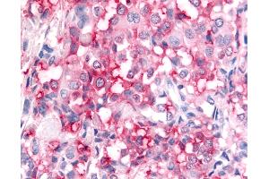 Anti-ADAMTS5 antibody IHC of human Breast, Carcinoma.