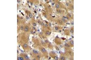Immunohistochemistry analysis in formalin fixed and paraffin embedded human hepatocarcinoma reacted with HPR Antibody (Center) followed by peroxidase conjugation of the secondary antibody and DAB staining. (HPR antibody  (Middle Region))