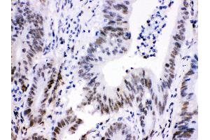 Anti- Cdk9 Picoband antibody, IHC(P) IHC(P): Human Intestinal Cancer Tissue (CDK9 antibody  (AA 141-372))