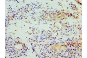 Immunohistochemistry of paraffin-embedded human breast cancer using ABIN7152008 at dilution of 1:100 (Stomatin antibody  (AA 55-288))