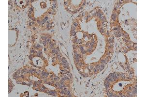 ABIN6269036 at 1/200 staining human colon cancer tissue sections by IHC-P.