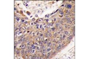 Formalin-fixed and paraffin-embedded human lung carcinoma tissue reacted with FXN antibody (C-term), which was peroxidase-conjugated to the secondary antibody, followed by DAB staining. (Frataxin antibody  (C-Term))