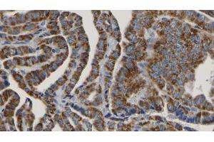 ABIN6267188 at 1/100 staining Human thyroid cancer tissue by IHC-P.