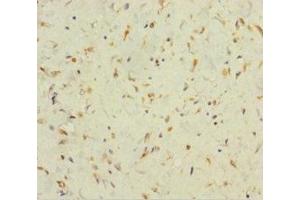 Immunohistochemistry of paraffin-embedded human colon cancer using ABIN7165526 at dilution of 1:100 (Protein FAM60A (SINHCAF) (AA 1-221) antibody)
