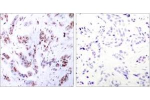 Immunohistochemistry analysis of paraffin-embedded human breast carcinoma tissue, using MEF2A (Ab-312) Antibody. (MEF2A antibody  (AA 279-328))