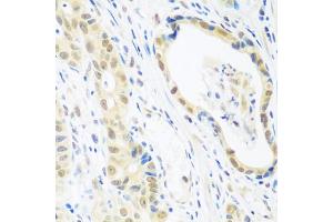 Immunohistochemistry of paraffin-embedded human stomach cancer using POLR2E antibody.