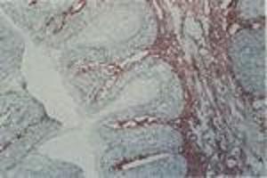 Carcinoma in situ, vulva (MAb EB2, tenascin) (TNC antibody)