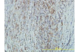 Immunoperoxidase of monoclonal antibody to TYK2 on formalin-fixed paraffin-embedded human lymphoma. (TYK2 antibody  (AA 276-375))