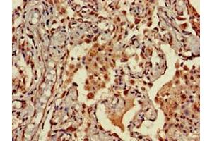 Immunohistochemistry of paraffin-embedded human lung cancer using ABIN7161610 at dilution of 1:100 (NINJ1 antibody  (AA 1-80))