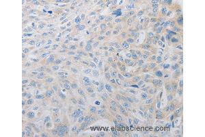 Immunohistochemistry of Human esophagus cancer using PDX1 Polyclonal Antibody at dilution of 1:30 (PDX1 antibody)