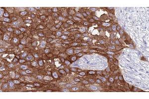ABIN6277050 at 1/100 staining Human Head and neck cancer tissue by IHC-P. (CD247 antibody  (C-Term))