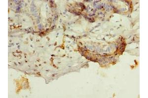 Immunohistochemistry of paraffin-embedded human breast cancer using ABIN7145275 at dilution of 1:100 (BATF antibody  (AA 1-125))