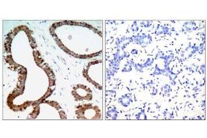 Immunohistochemical analysis of paraffin-embedded human breast carcinoma tissue, using 14-3-3 ζ (Ab-58) antibody (E021188). (14-3-3 zeta antibody)