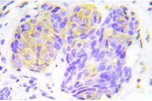 Immunohistochemistry (IHC) analyzes of p-4E-BP1 antibody in paraffin-embedded human lung adenocarcinoma tissue. (eIF4EBP1 antibody  (pThr45))