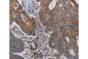 Immunohistochemistry of Human thyroid cancer using CYP7A1 Polyclonal Antibody at dilution of 1:20 (CYP7A1 antibody)