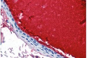 Human Breast, Ductal with Secretion (formalin-fixed, paraffin-embedded) stained with LTF antibody ABIN337355 at 10 ug/ml followed by biotinylated anti-mouse IgG secondary antibody ABIN481714, alkaline phosphatase-streptavidin and chromogen. (Lactoferrin antibody)