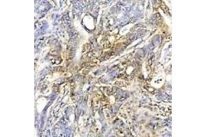 Immunohistochemistry analysis of human colon cancer tissue using HSP70 mAb (C92F3A-5) at a dilution of 1:50.