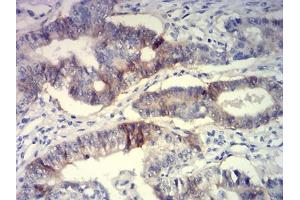 Immunohistochemical analysis of paraffin-embedded lung cancer tissues using CD239 mouse mAb with DAB staining. (BCAM antibody  (AA 32-197))