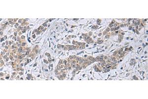 Immunohistochemistry of paraffin-embedded Human colorectal cancer tissue using SLC4A3 Polyclonal Antibody at dilution of 1:35(x200) (SLC4A3 antibody)