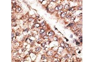 IHC analysis of FFPE human hepatocarcinoma tissue stained with the BMP3 antibody (BMP3 antibody  (AA 8-36))