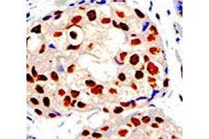 IHC analysis of FFPE human breast carcinoma tissue stained with the PRMT1 antibody (PRMT1 antibody  (AA 316-347))