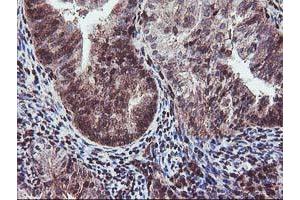 Immunohistochemical staining of paraffin-embedded Adenocarcinoma of Human endometrium tissue using anti-SETD7 mouse monoclonal antibody.