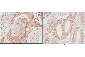 Immunohistochemical analysis of paraffin-embedded human lung cancer (A) and rectal cancer (B), showing cytoplasmic localization using DDX4 mouse mAb with DAB staining. (DDX4 antibody)
