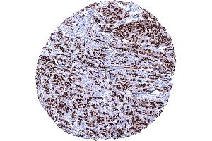 Invasive breast cancer of no special type NST with strong PR immunostaining in 100 of tumor cells (Recombinant Progesterone Receptor antibody  (AA 1-200))