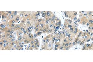 Immunohistochemistry of paraffin-embedded Human liver cancer using TXNDC5 Polyclonal Antibody at dilution of 1/40