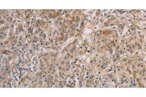 Immunohistochemistry of paraffin-embedded Human gastic cancer using ESRRG Polyclonal Antibody at dilution of 1:30 (ESRRG antibody)