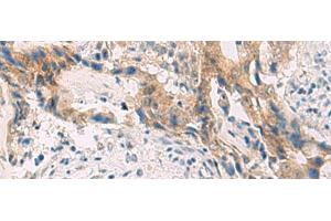 Immunohistochemistry of paraffin-embedded Human cervical cancer tissue using PCYT2 Polyclonal Antibody at dilution of 1:55(x200)