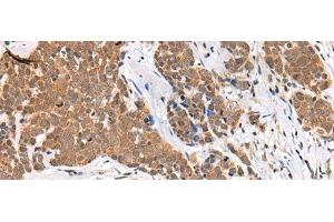 Immunohistochemistry of paraffin-embedded Human thyroid cancer tissue using CHAMP1 Polyclonal Antibody at dilution of 1:40(x200)