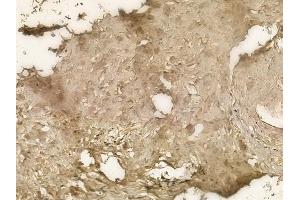 ABIN6258914 and ABIN6273666 at 1/100 staining human testicular cancer by IHC-P.